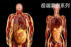一个32岁女生7年里每天一杯奶茶一个蛋糕，肝脏发生了什么变化？