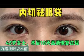 42岁女士内切祛眼袋手术，术前、术后即刻、术后10天恢复过程高清