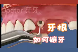 牙根还能这样镶牙又省了一笔！动画演示牙齿里打桩是怎么打的
