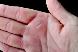 烫伤后红印多久能消退？用什么药膏管用？药师专业科普