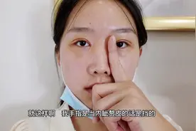 双眼皮术后护理也是很重要的可以加快恢复，七天拆线恢复情况效果