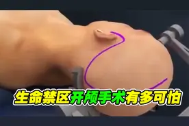 生命禁区开颅手术全过程，任何一步都不能出错，3D动画演示
