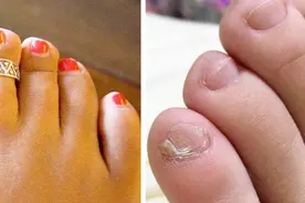 很多中国人的小脚趾，为什么都有两瓣指甲？说出的原因你可能不信