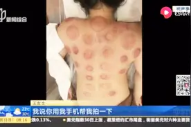 大姐去纤体机构拔罐，拔完出现大片水泡，去医院一检查直接气炸了视频封面