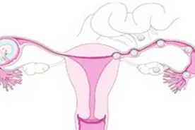 左侧附件囊肿对身体的影响严不严重？一定要检查清楚病症！