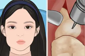 美女口腔得了蛀牙，沉浸式体验医生清理蛀牙全过程，视频超级解压视频封面