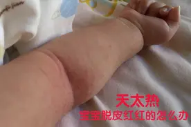 森妈坐月子21天小宝宝下巴和胳膊肘处脱皮红红的，什么方法可以消视频封面