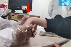 手背长个包，可能是腱鞘囊肿，专业手法处理！