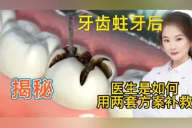 医学演绎 人体牙齿蛀牙，看医生如何利用两套方案治疗 牙套牙冠视频封面