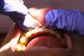 长沙牙齿矫正 | 戴牙套期间，如何洗牙？