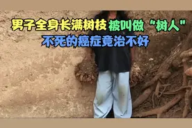 男子全身长满树枝，被叫做“树人”！！视频封面