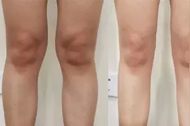 膝盖内侧鼓包堆肉、腿不直怎么办？1招改善，腿直了也细了！