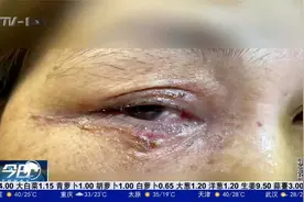 拍完虫子顺手揉眼睛，女子右眼溃烂，耳后还留下长疤！视频封面