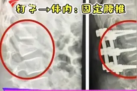 蹦床安全隐患大！11岁女童蹦床蹦到腰椎骨凸出，家长需注意看管！视频封面
