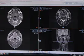 广西医科大学附属肿瘤医院在鼻咽癌的放射治疗上有哪些突破？视频封面