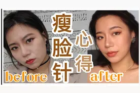 瘦脸针经验分享 瘦脸针前后对比视频封面