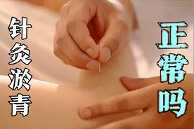 针灸后出现淤青，是排病表现吗？中医：仅仅是皮肤表现，不必担心视频封面