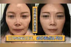真人案例：53岁做拉皮，术后20天，老公差点认不出视频封面