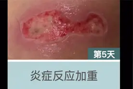 热水袋低温烫伤愈合全过程