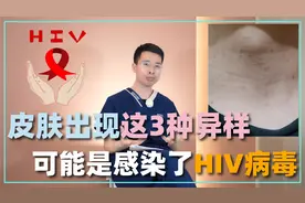 皮肤出现这3种异样，不仅仅是皮肤病，或是感染了HIV病毒视频封面