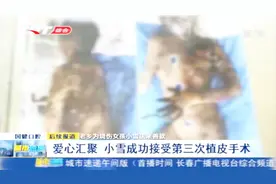 榆树烧伤女孩后续：小雪成功接受第三次植皮手术，尚未脱离感染期视频封面