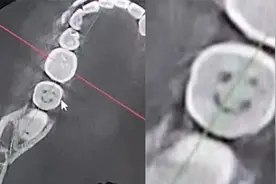 女子补牙发现蛀牙是笑脸表情，当事人：感觉很开心，牙医说很害怕