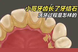 牙齿上长了牙结石是怎么清理的？动画演示清理过程