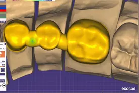 快来跟牙宝一起学习怎样用EXOCAD软件快速简单的设计后牙内冠桥