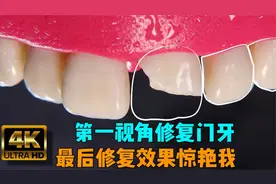 你女朋友磕掉半颗门牙，天天啃不了骨头，最后的修复效果惊艳了我视频封面