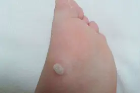 脚上磨出了水泡怎么处理？这种情况可不要挑破，应该这样处理