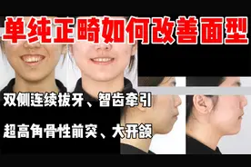 超高角骨龅开颌，双侧智齿牵引，挑战关闭15mm-16mm超长拔牙间隙视频封面