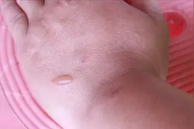 做饭烫出水泡，用缝衣针挑破，据说恢复效果很好，不知是否科学？视频封面