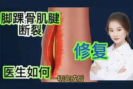 医学演绎 人体脚后跟脚踝骨里侧肌腱断裂怎么办 医生这样修复视频封面