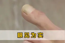 美国女子大脚趾异于常人，长到一脱鞋直接弹出，买鞋得大2个码视频封面