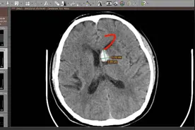 CT入门教学（三）：脑出血在CT上表现及出血量的估算