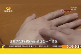 警惕！手上出现“蜘蛛痣”，可能是肝病！专家：这是警告！视频封面