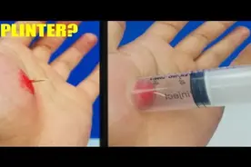 木刺深深的扎进肉里取不出来咋办？别急，看看牛人是这样解决的！