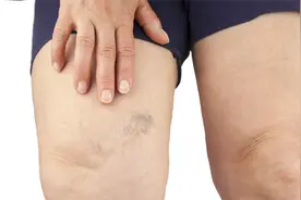 腿上时不时有淤青，不一定是碰伤的，另外三种原因要严肃对待视频封面