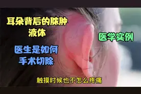 医学手术实例 一个女孩耳朵背后的脓液肿胞 医生是如何治疗处理视频封面