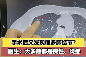做完手术后又发现很多肺结节？医生：不用太惊慌，很多都是良性的视频封面