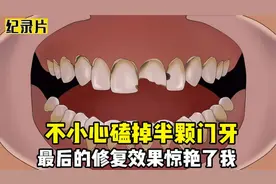 美女不小心磕掉半颗门牙，说话一直漏风，最后的修复效果惊艳了我视频封面