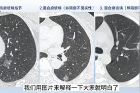 磨玻璃肺结节，手术后复发风险有多高？医生用CT片分析真相视频封面