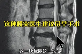 两腿交替疼痛麻木，会阴部针刺感，这种椎间盘突出建议尽快手术