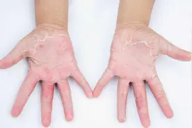 小孩手指脱皮是怎么回事？别手贱再给撕掉了,两招还宝宝水嫩皮肤