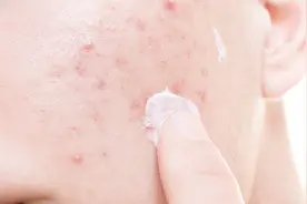 阿达帕林凝胶的用法是什么？治疗轻、中重三度痤疮，用法各有不同