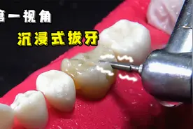 根管治疗蛀牙全过程，看着就觉得痛...大家一定要好好刷牙啊！视频封面