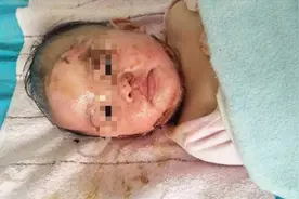 幼儿被烫伤，宝妈按常识用冷水冲，送医院医生却说这样太冲动