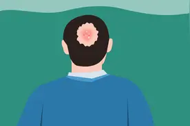 脂溢性脱发能治好吗？听听专业医生怎么说！