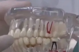 干细胞注射长出牙槽骨，让牙齿再生不是梦，为口腔患者带来希望视频封面