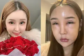 女网红整容上瘾，花费百万整容失败，如今毁容严重连亲妈都认不出视频封面